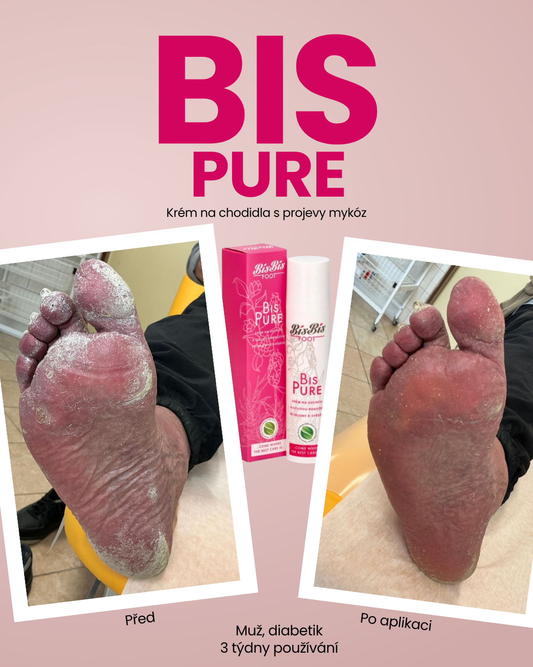 Bis Pure před a po diabetik